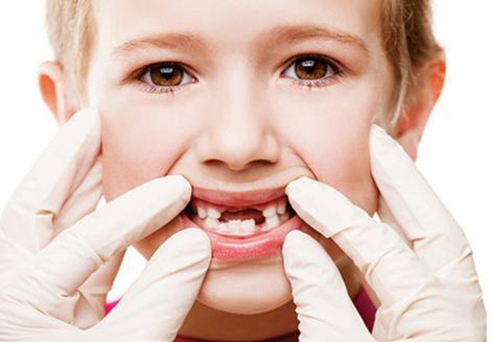 Sâu răng ở trẻ em: Nguyên nhân, dấu hiệu nhận biết lúc mới chớm
