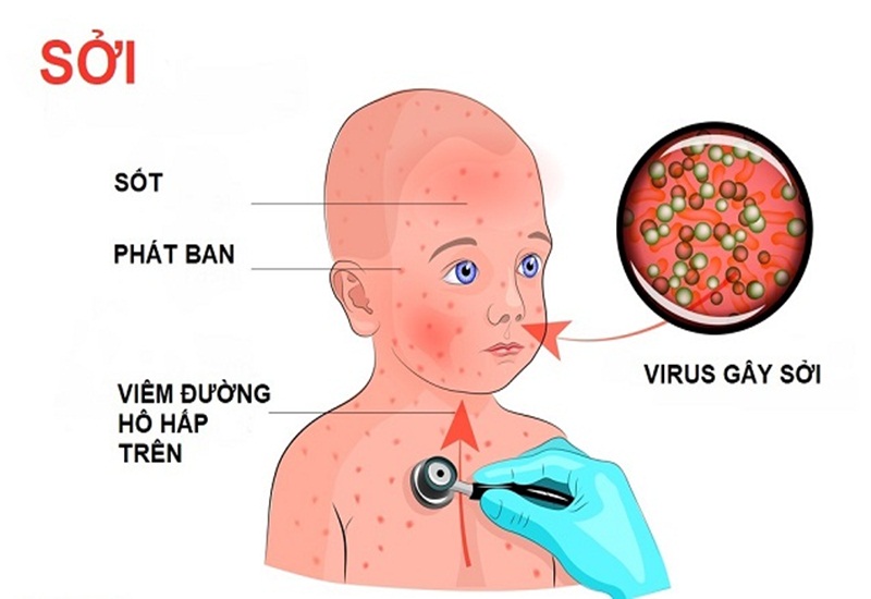 Cần phân biệt bệnh sởi và sốt phát ban để đưa ra phương pháp điều trị hiệu quả